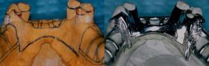 Before and after image of prosthodontic models